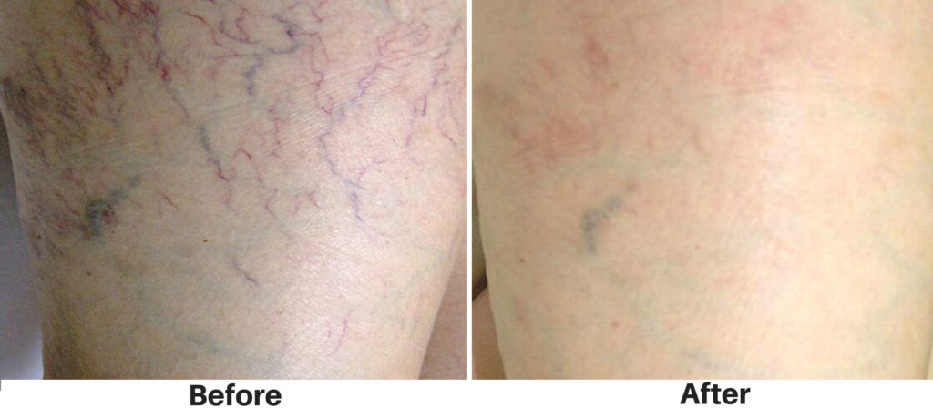 Spider Vein Removal - Rejuvie Aesthetic and Dermatology Bali