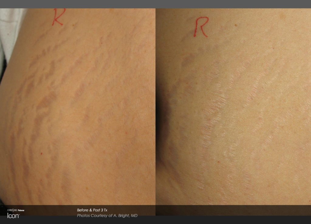 Icon Stretch Mark Removal Bali Med Spa